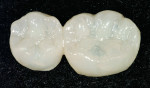 Figure 21  An occlusal view of the completed provisional restoration for teeth Nos. 29 and 30.