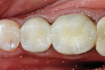 Figure 22  An occlusal view of the completed provisional restoration. Note the translucent effect in the cuspal areas created by the layered provisional materials.