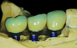 CAD/CAM abutments and PFM crowns seated on the Robocast.