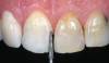 Fig 7. Lower titanium bar structure with denture teeth processed in acrylic against upper PFM restoration in three sections at insertion.