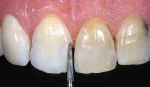 Figure 2  Breaking contact with the 5850-012 diamond on a demonstration model that has natural teeth mounted in it.