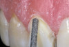 Fig 8. Five-year follow-up. Severe wear. Some chipping of ceramic facings of upper anterior PFM restorations against lower denture teeth. Wear changes incisal relationship from a Class I to end-to-end occlusion.