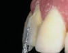 Fig 10. Ten-year follow-up. Worn denture teeth and multiple repairs.