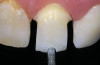 Fig 12. Anterior and posterior teeth in contact.