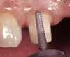 Fig 17. Crowns inserted with temporary cement.