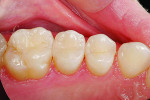 Figure 2 Outstanding results can be achieved using DENTSPLY Caulk's stepwise approach, as with this completed Class II restoration on the disto-occlusal of tooth No. 4. Clinical photograph courtesy of Dr. Stehen Poss.
