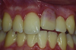 Figure 1 Maxillary left incisor before extraction in 2006.