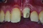 Figure 4 Maxillary left incisor zirconia custom abutment in 2006.