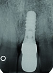Figure 11 Radiographic at 21-month follow-up appointment in 2011.