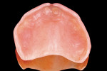 Figure 1  The internal surface of an ill-fitting maxillary overdenture.