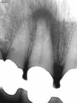 Figure 2  Pretreatment radiograph of maxillary right central incisor demonstrating a large apical lesion. (Photograph courtesy of Dr. Gilberto Debelian.)
