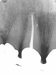 Figure 3  Twenty-four month postendodontic treatment with Resilon demonstrating complete resolution of the apical lesion and sealer filling a lateral canal. (Photograph courtesy of Dr. Gilberto Debelian.)