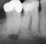 Figure 4  Apical lesion present on lower right second molar before endodontic treatment. (Photograph courtesy of Dr. Dan Shalkey.)