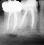 Figure 5  Radiograph immediately following Resilon obturation of lower right second molar with apical lesion present. (Photograph courtesy of Dr. Dan Shalkey.)