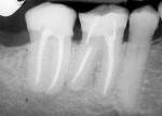 Figure 6  Twenty-nine month postendodontic treatment with Resilon demonstrating complete resolution of the apical lesion. (Photograph courtesy of Dr. Dan Shalkey.)