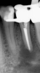 Figure 7  Large periapical lesion present following Resilon obturation. (Photograph courtesy of Dr.Winfried Zeppenfeld.)