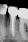 Figure 8  Ten-month postendodontic obturationdemonstrating complete resolution of theapical lesion. (Photograph courtesy of Dr.Winfried Zeppenfeld.)
