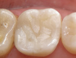 Figure 2  Indirect inlays or onlays made of composite or porcelain make ideal replacement restorations for large amalgam restorations, offering the patient the esthetics of a tooth-colored restoration while conserving tooth structure.