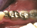 Figure 3  For many years, the partial gold restoration was the standard of care for conservative, high-quality, long-term restorations.