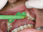 Figure 3  Injecting the light-body Correct Flow using the intraoral tip around the crown preparations.