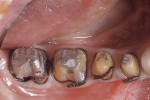 Figure 6  Crown preparations on teeth Nos. 29 through 31. (Dentistry by Dr. Robert Zena.)