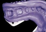 Figure 7  Flexitime Easy Putty is not fully set in the tray after removal from the mouth.