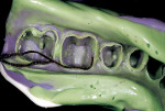 Figure 9  After setting, the impression is removed from the mouth and demonstrates the fine detail of the preparation margins and preparation.