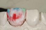 Figure 10 Characterization of anatomy and color were built with enamel and opalescence.