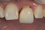Figure 16 Gingival margin to incisal proportion was assessed at the try-in.