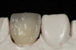 Figure 13 Mesial shape and contact were assessed.