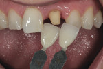 Figure 1 Clinician and technician used custom shade tabs to choose enamel and translucency.