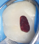 Figure 3 Inflamed hyperaemic pulp was revealed in initial access.