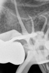 Figure 6 Cone-fitting radiographs showing the
severe curvatures of the mesiobuccal canals.