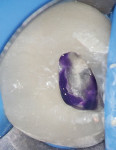 Figure 8 Orifice sealed with purple composite before closing access.
