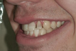 Figure 7 Left lateral view of the patient’s teeth following removal of the braces.