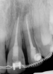 Figure 5 Radiograph taken at
the orthodontic appointment in May.