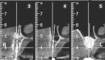 Figure 20 5-month postoperative CBCT cross-sectional views of site Nos. 12 through 14 revealed substantial vertical and horizontal bone augmentation as well as
successful sinus floor elevation.