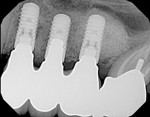 Figure 23 Case 2 periapical radiograph of implant-supported prosthesis 6 months in function.