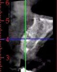 Figure 25 6-month postoperative CBCT cross-sectional view revealed bone growth to full extension of horizontally and vertically placed bone pins.