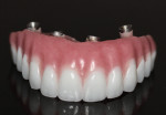 Figure 1 Existing acrylic hybrid denture.