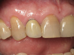 Figure 1  Existing PFM crown on tooth No.7.