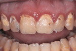Figure 1 Patient with less than ideal hygiene needed both anterior and posterior restorations.