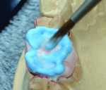 Figure 11 Forming the occlusal table by connecting “dots” and “lines.”
