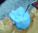 Figure 16 Building ridges within the occlusal
table and defining primary anatomy with the
instrument.