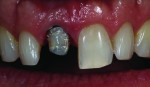 Figure 1 Assessment of tooth colors includes the stump shade and the incisal one-third lesion.
