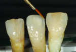 Figure 4 Natural teeth were helpful tools for practicing staining effects.