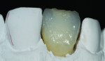 Figure 10 Fired restoration after first addition of incisal characterization.