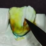 Figure 18 Crack line is accentuated extending
from incisal edge.