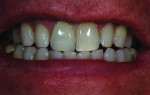 Figure 24 The color is not right in the patient’s
mouth at the first try-in visit.
