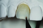 Figure 27 Additional cervical translucent color
was used to recreate the incisal lesion.